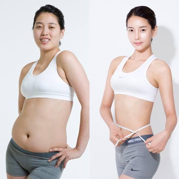 Hướng dẫn chăm sóc sau hút mỡ bụng