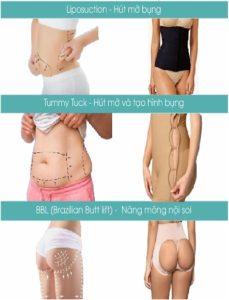 Hình ảnh minh họa các phương pháp thẩm mỹ như hút mỡ bụng (Liposuction), hút mỡ và tạo hình bụng (Tummy Tuck), và nâng mông nội soi kiểu Brazil (BBL - Brazilian Butt Lift). Bên cạnh đó là hình ảnh các loại đồ định hình chuyên dụng mặc sau phẫu thuật, hỗ trợ phục hồi và giữ dáng sau can thiệp thẩm mỹ."
