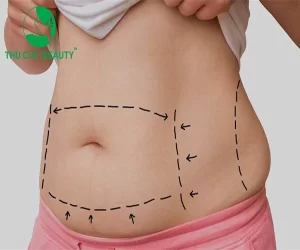 hình ảnh mô phỏng khu vực trước khi hút mỡ bụng