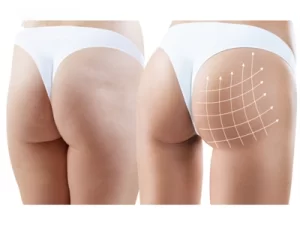 Hướng Dẫn Chọn Đồ Lót Định Hình Sau Phẫu Thuật Hướng Dẫn Chọn Đồ Lót Định Hình Sau Phẫu Thuật