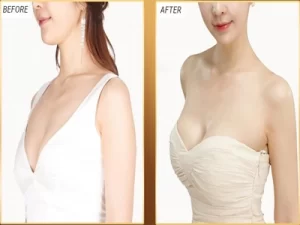 Áo Định Hình Tạo Khe Ngực Ann Chery 5130-5150 : Bí Quyết Cho Vòng 1 Đẹp Tự Nhiên, An Toàn Sau Phẫu Thuật Áo Định Hình Tạo Khe Ngực Ann Chery: Bí Quyết Cho Vòng 1 Đẹp Tự Nhiên, An Toàn Sau Phẫu Thuật