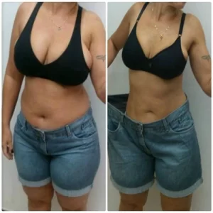 So sánh trước và sau hút mỡ bụng – vóc dáng thay đổi rõ rệt, vòng eo nhỏ gọn, cơ thể săn chắc hơn. So sánh trước và sau hút mỡ bụng – vóc dáng thay đổi rõ rệt, vòng eo nhỏ gọn, cơ thể săn chắc hơn.